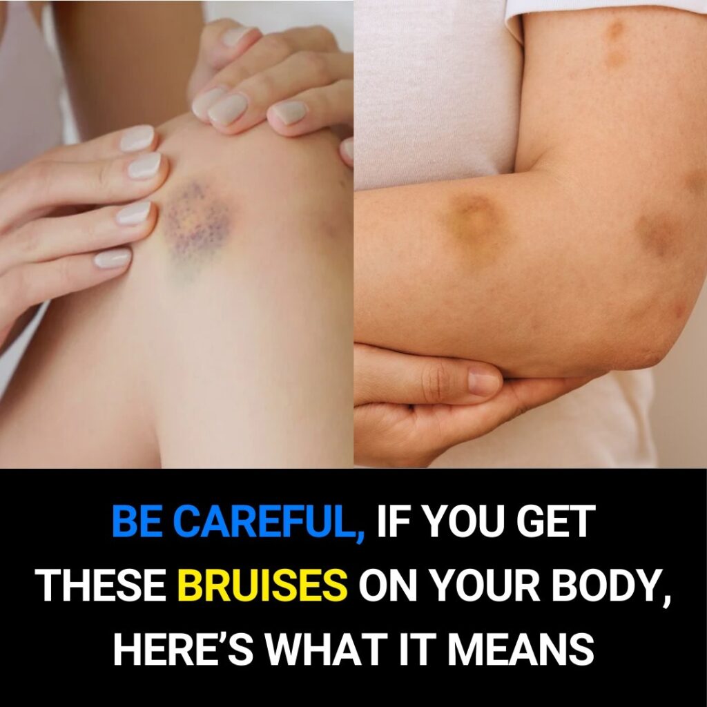 If You Get These Bruises on Your Body… Here’s What It Means – USA